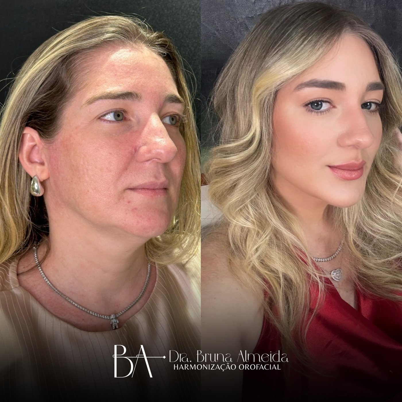 Resultado de harmonização orofacial, antes e depois