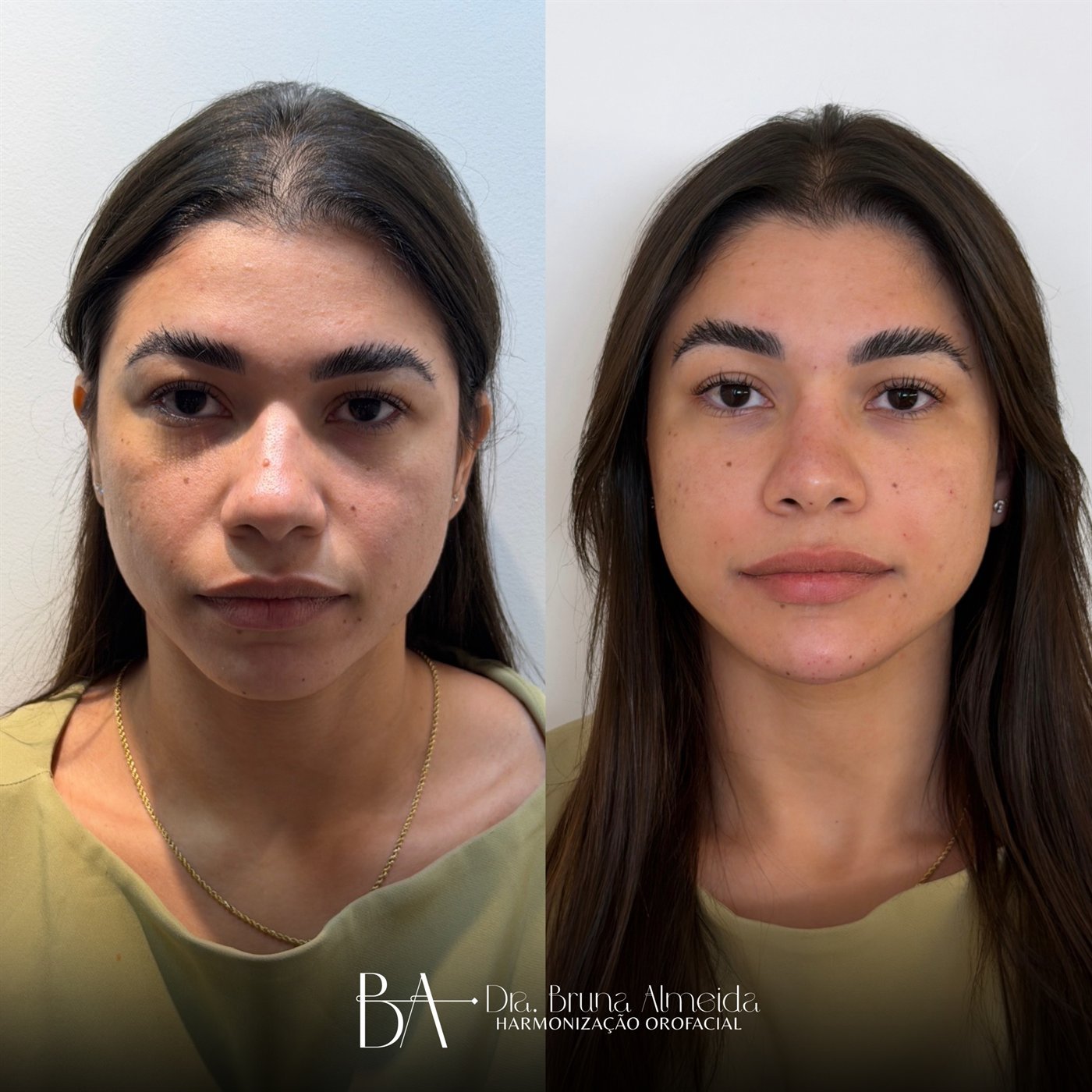 Resultado de harmonização orofacial, antes e depois