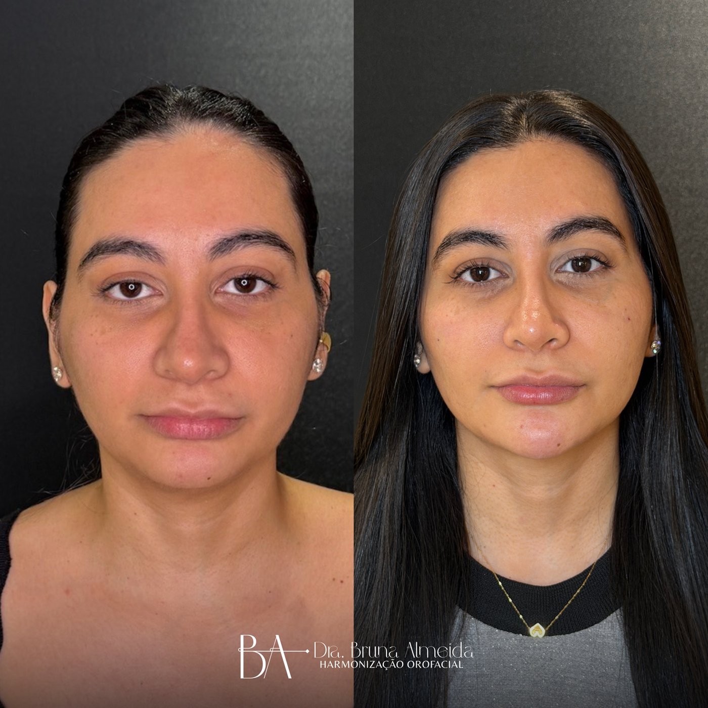 Resultado de harmonização orofacial, antes e depois