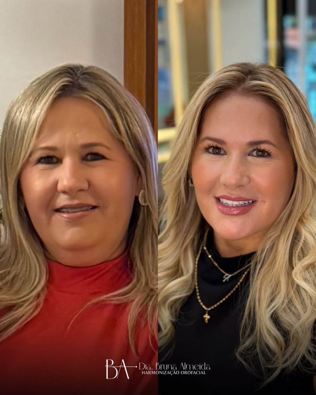 Resultado de harmonização orofacial, antes e depois