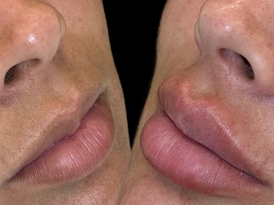 Preenchimento labial