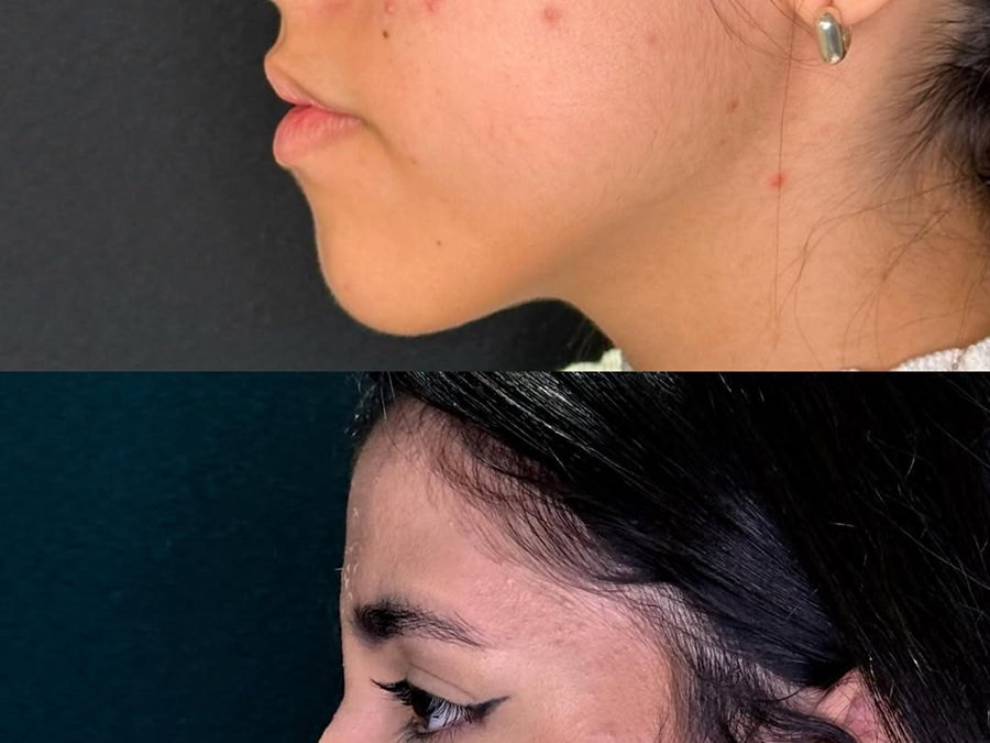Rinomodelação, antes e depois