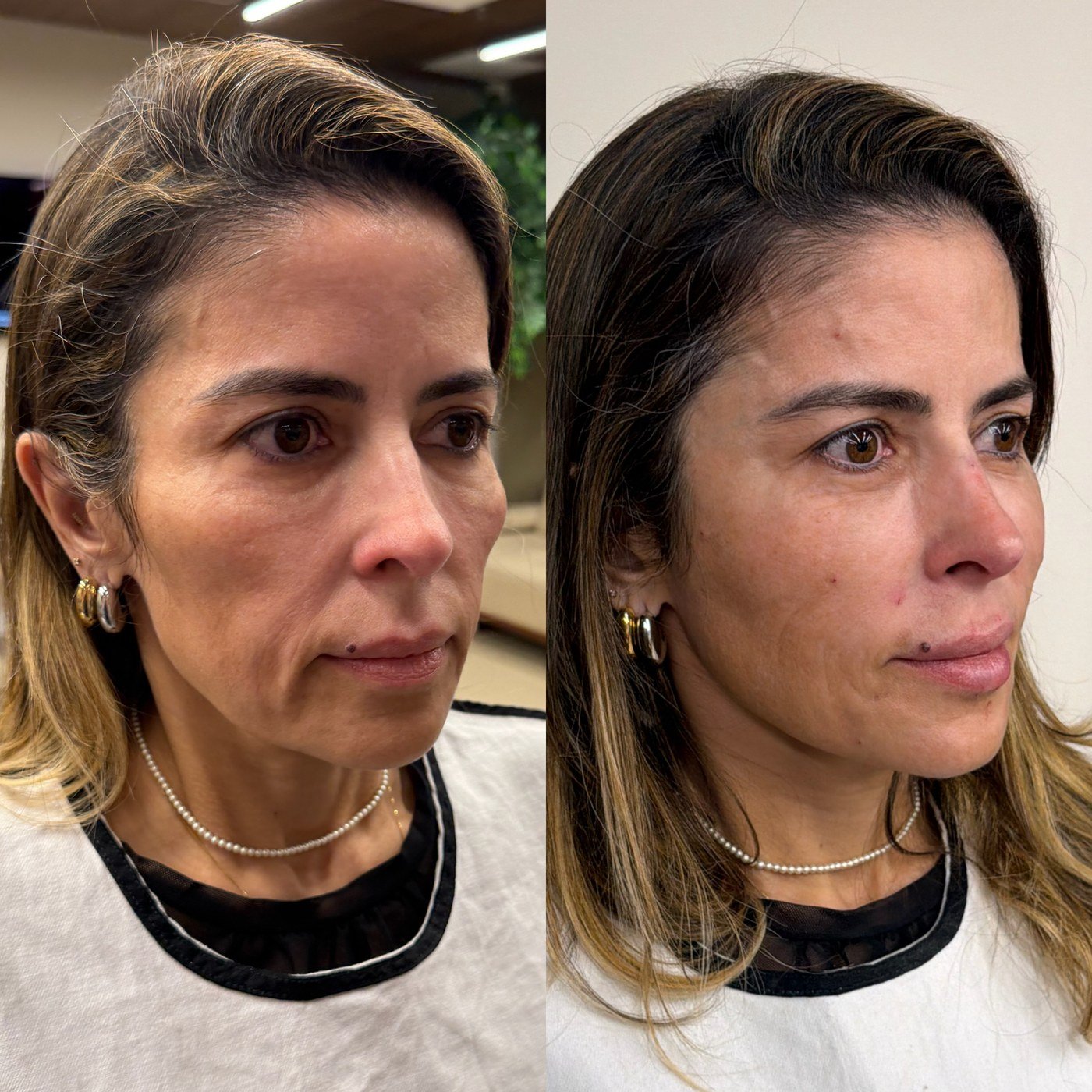Resultado de harmonização orofacial, antes e depois