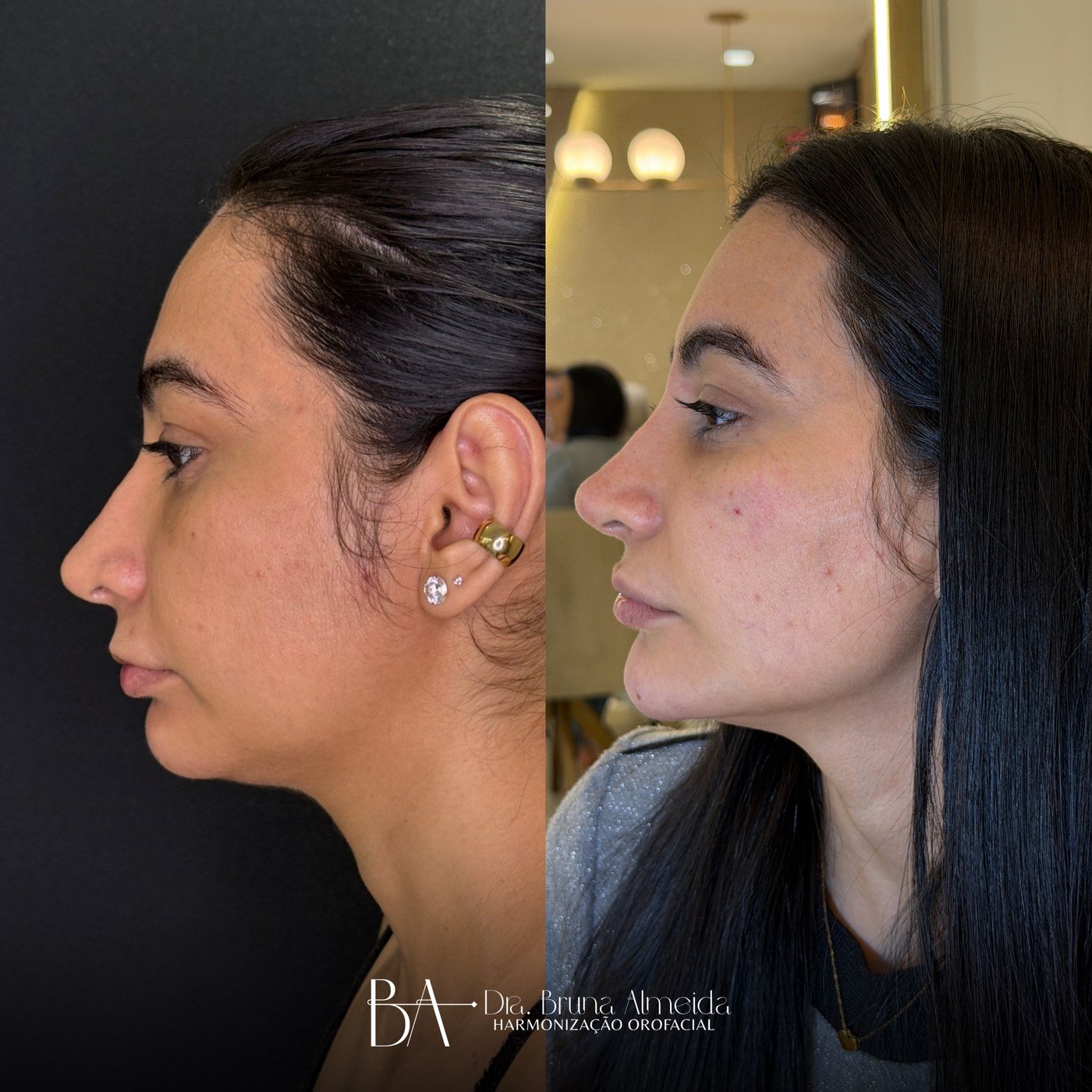 Resultado de harmonização orofacial, antes e depois