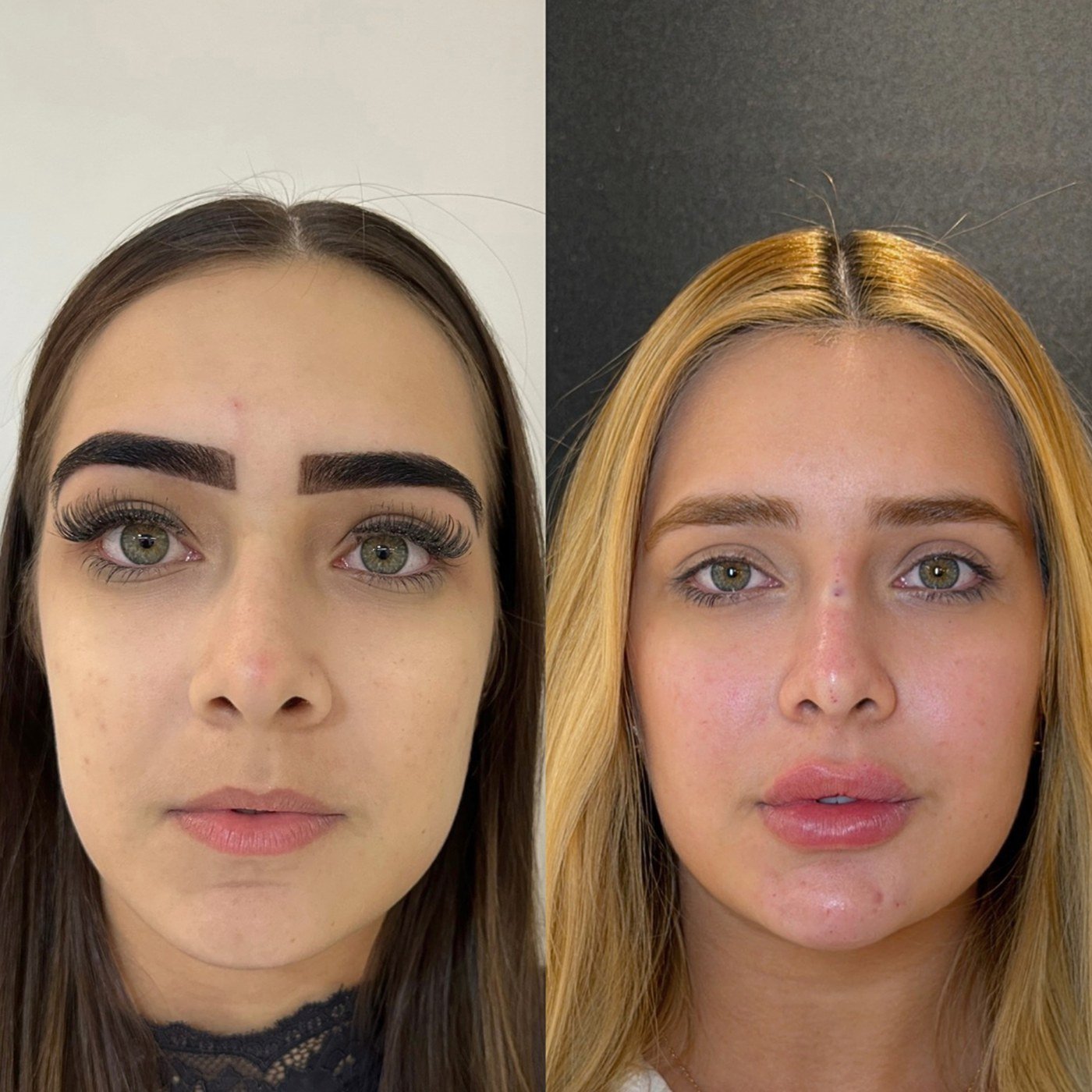 Resultado de harmonização orofacial, antes e depois