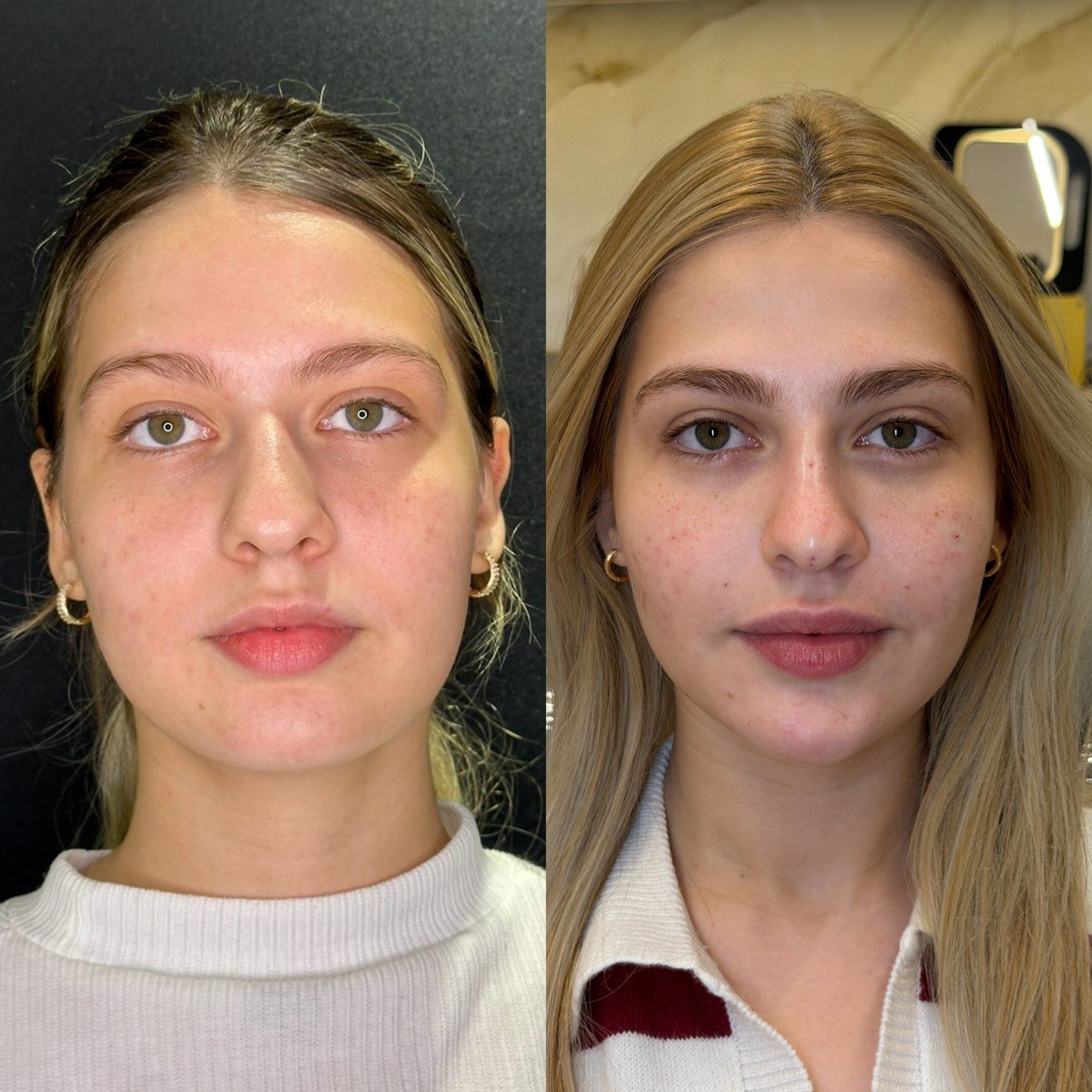 Resultado de harmonização orofacial, antes e depois
