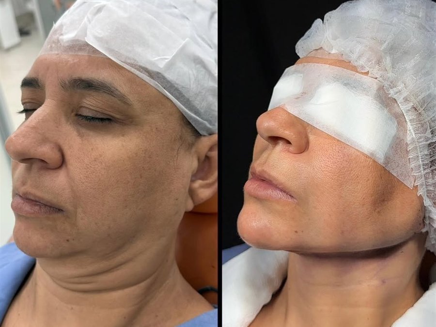 Contorno e definição de mandíbula
