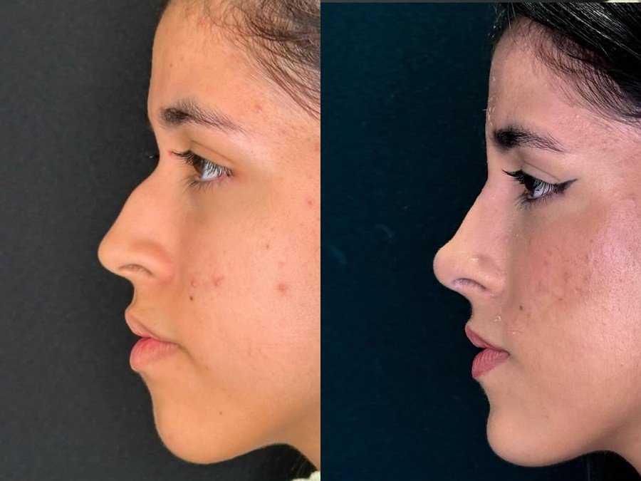 Rinomodelação, antes e depois