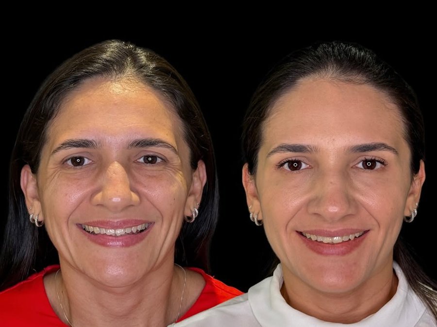Aplicação de toxina botulínica